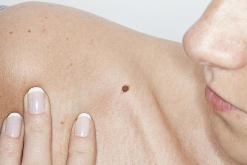 Skin Cancer Early Detection: How to Check Moles and Spots for Signs or Symptoms