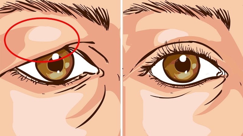 How To Treat Droopy Eyelids Naturally! The Results Are Amazing!