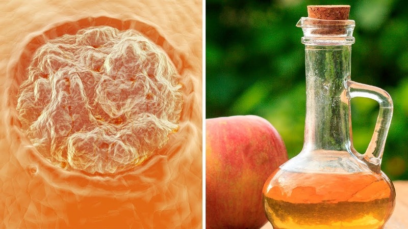 Quickly Remove Warts With Just One Ingredient